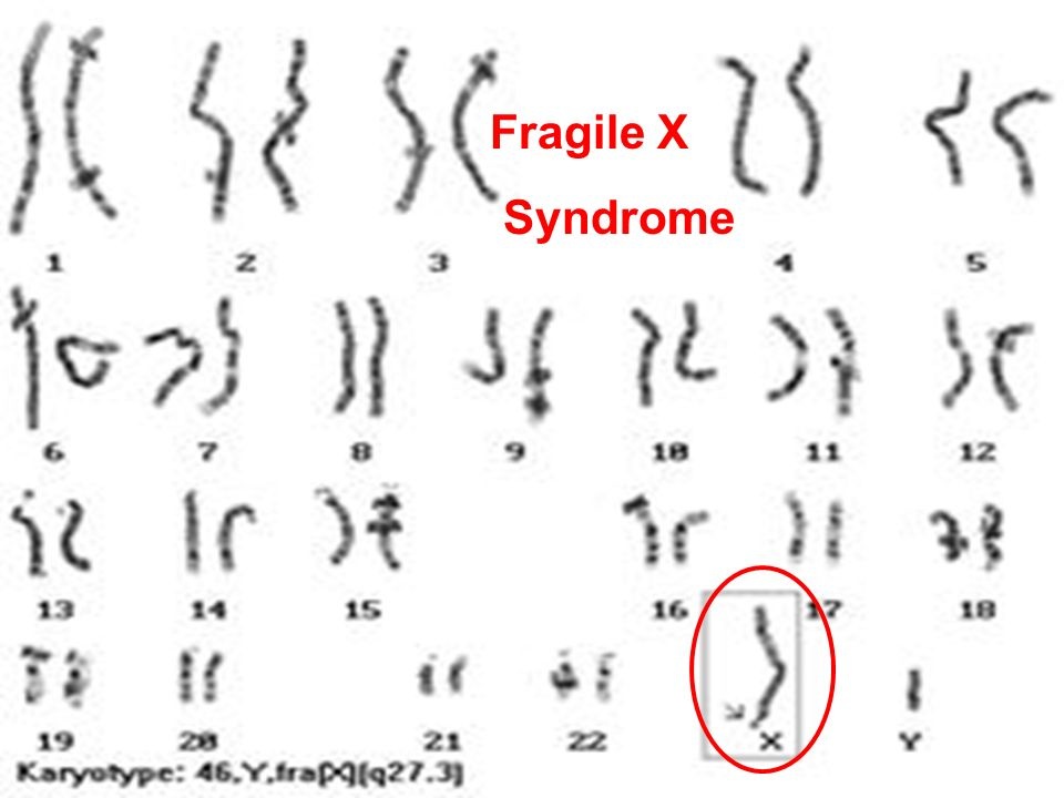 Diagnosis Fragile X Syndrome